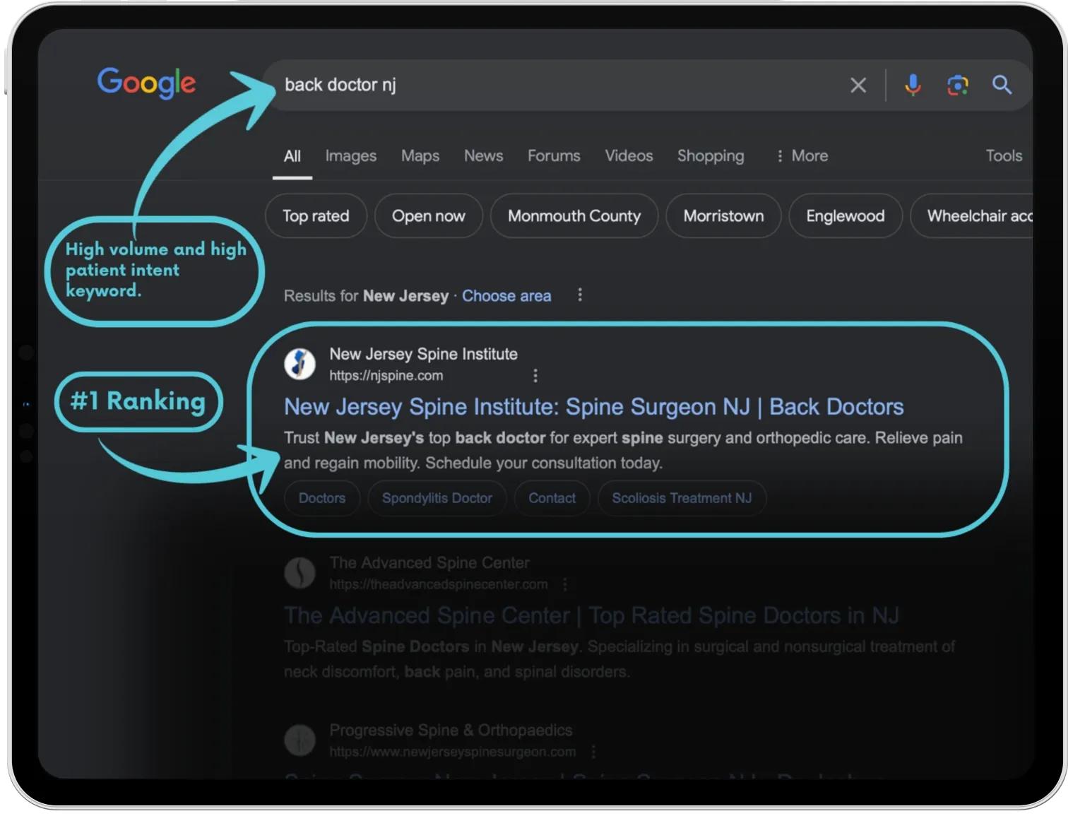 Google search results showing the spine practice ranked #1 for "back doctor NJ" — an actual Hexapoint Health client ranking
